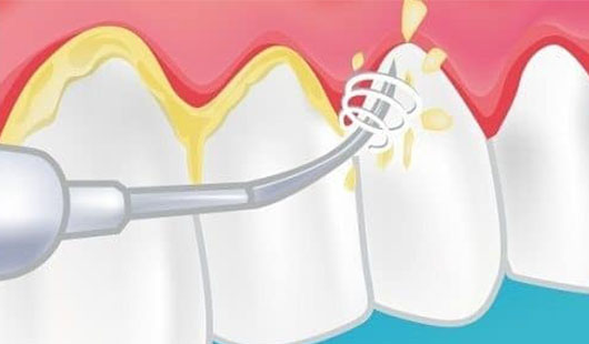 limpieza dental guadalajara airflow