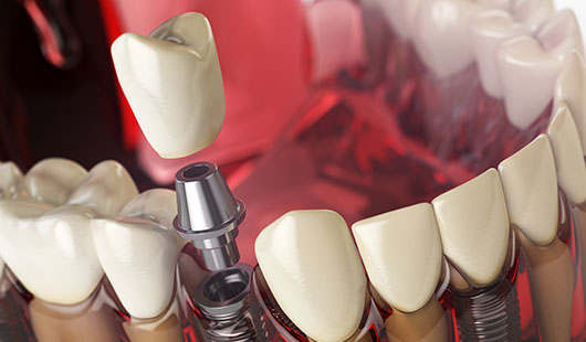 implantes dentales guadalajara